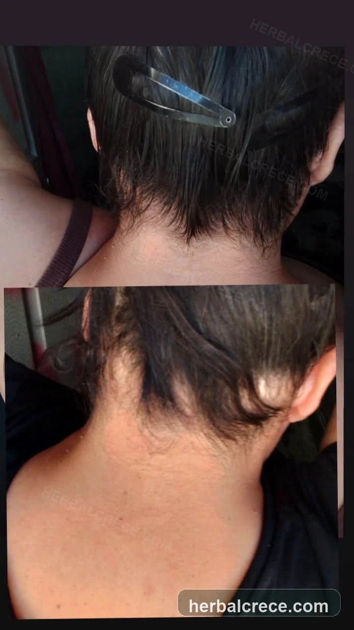 Caso real de antes y después con Herbal Crece